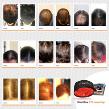 Load image into Gallery viewer, illumiflow 272 Pro Max Laser Cap - Max Hair Growth - Clinical Strength - Money-Back Guarantee