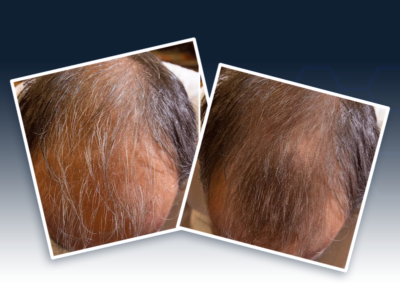 Illuminate Your Hair Regrowth Journey with FDA-Cleared Laser Caps from illumiflow