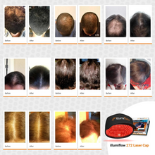 Load image into Gallery viewer, illumiflow 272 Laser Cap Bundle Laser Cap + DHT Blocking Vitamins + Hair Growth Guide (eBook)
